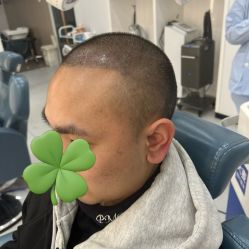 -大麦微针植发全国连锁