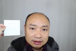 -大麦微针植发丨全国连锁