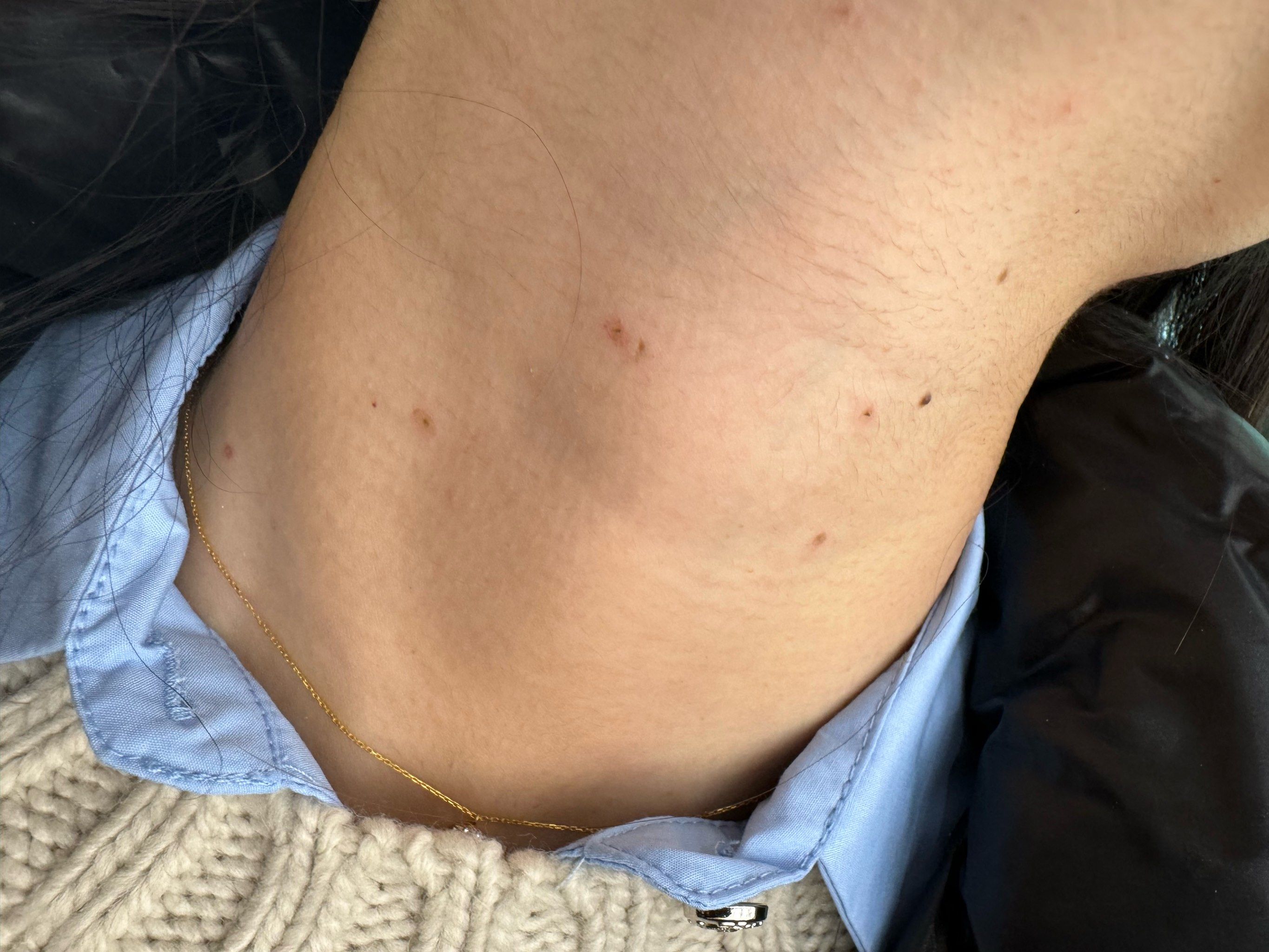 平时熬夜睡眠不好,脖子上长了好多疣,来这