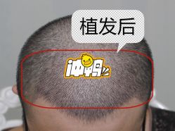 -大麦微针植发全国连锁