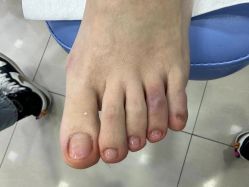 -德哥灰指甲脚气甲沟炎跖疣护理