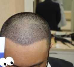 -大麦微针植发丨全国连锁