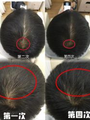 -菩叶脱发白发中心