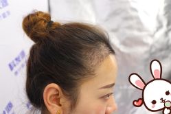 -大麦微针植发丨全国连锁