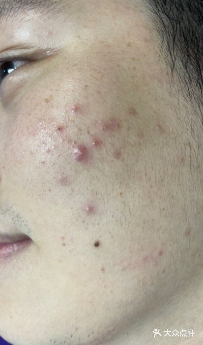 sor索尔专业祛痘百城连锁(公明店)图片