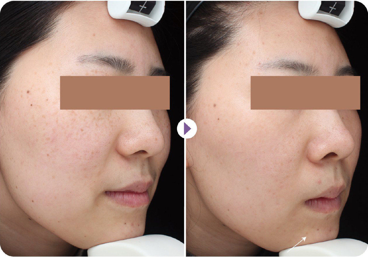 picoway超皮秒祛斑效果大公开!分享来啦