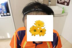 -大麦微针植发丨全国连锁