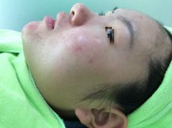 -苗医生草本科技祛痘