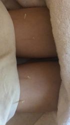 -肥三针腧穴瘦身馆