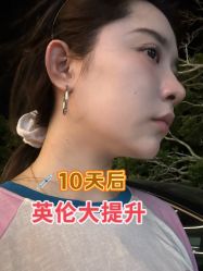 体验前-苏州维多利亚美容医院
