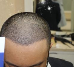 -大麦微针植发丨全国连锁