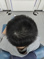 -大麦微针植发全国连锁