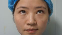 -天津健丽·去眼袋医疗美容机构