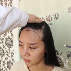 -大麦微针植发丨全国连锁