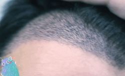 -大麦微针植发丨全国连锁