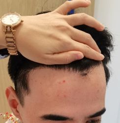 -大麦微针植发丨全国连锁