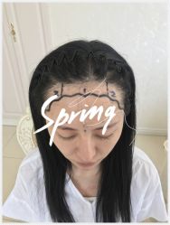 -大麦微针植发全国连锁