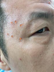 -百年美肤堂祛痦痣祛斑祛疣