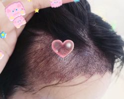 -大麦微针植发全国连锁