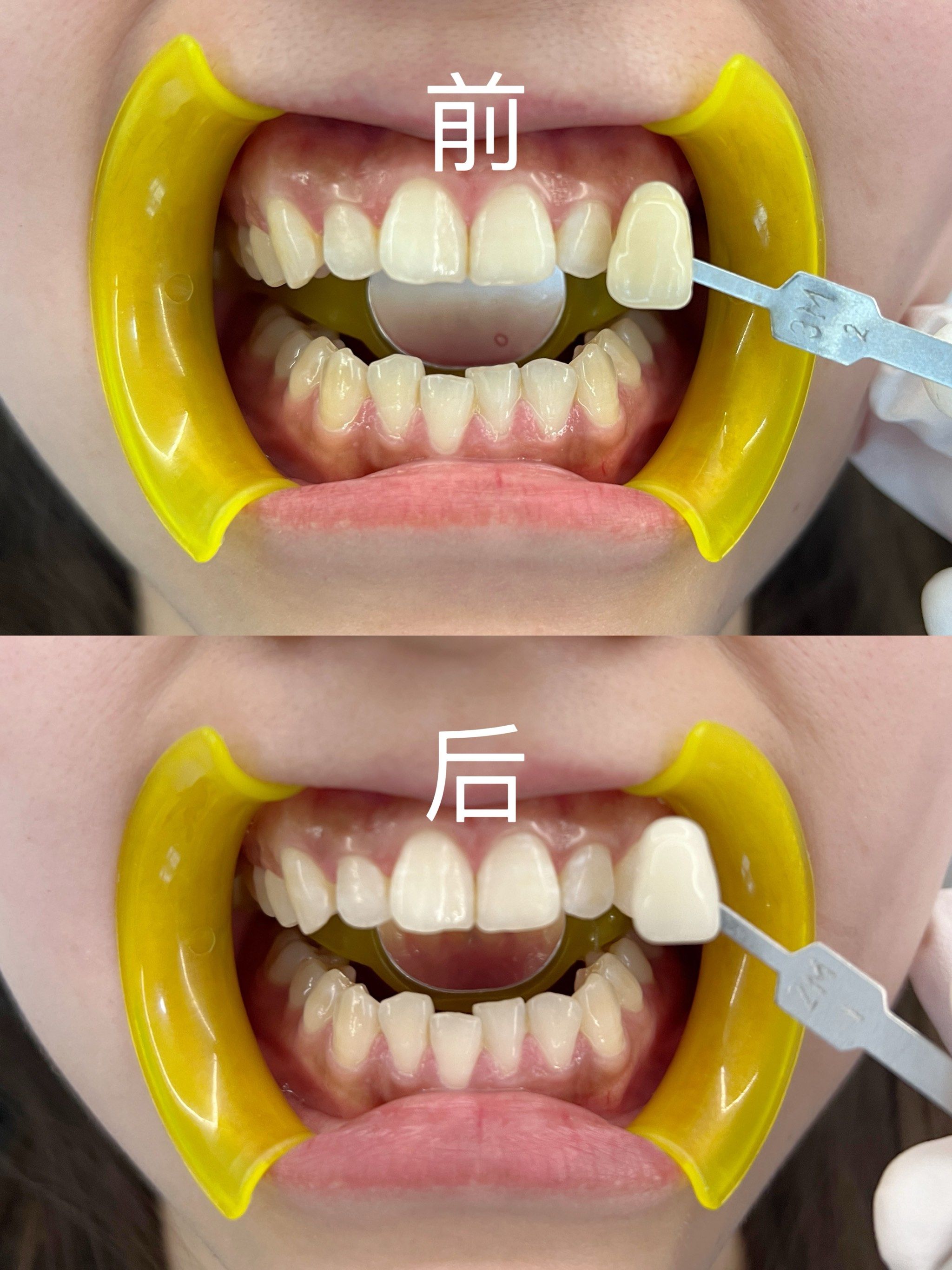 第一次体验植物美白牙齿