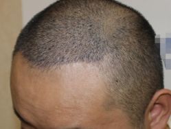 -大麦微针植发全国连锁