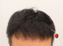 -大麦微针植发全国连锁
