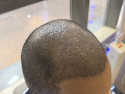 -碧莲盛·不剃发植发