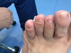 -Andrew指甲专科灰指甲·甲沟炎矫正·3D步态矫形鞋垫定制(浦三路店)