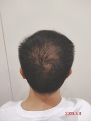 -碧莲盛·不剃发植发