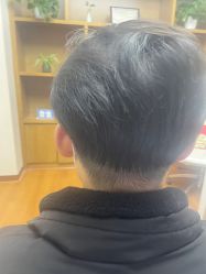 -大麦微针植发全国连锁