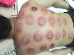 -悦艾堂·中医拔罐减肥·美体艾灸连锁