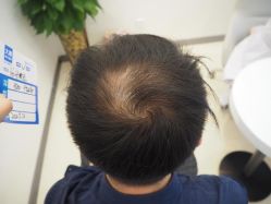 -大麦微针植发丨全国连锁