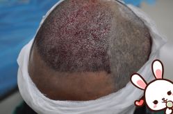 点击看大图 -大麦微针植发丨全国连锁