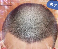 -大麦微针植发全国连锁