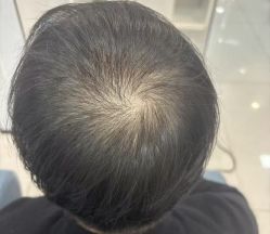 -大麦微针植发丨全国连锁