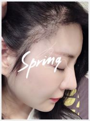 -大麦微针植发全国连锁