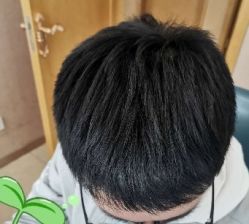 -大麦微针植发丨全国连锁