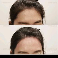 点击看大图 -小梨·OndaPro·专业脱毛连锁机构