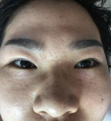 -美丽人生祛斑扁平疣汗管瘤中心
