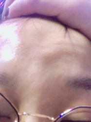 体验后-紫洁俪方（北京）医疗美容