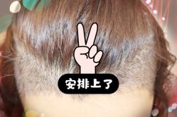 -大麦微针植发全国连锁