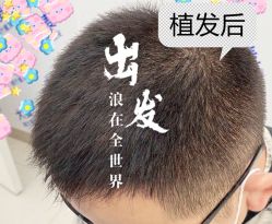 -大麦微针植发全国连锁