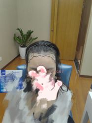 -大麦微针植发全国连锁