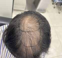 -碧莲盛·不剃发植发