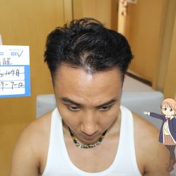 -大麦微针植发丨全国连锁