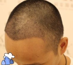 -大麦微针植发丨全国连锁