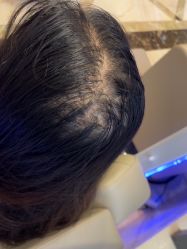 -碧莲盛·不剃发植发