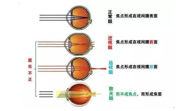 屈光不正是什么意思?