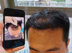 -碧莲盛·不剃发植发