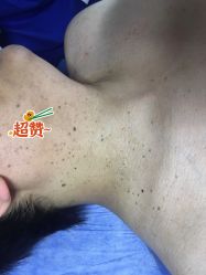 -美丽人生祛斑扁平疣汗管瘤中心